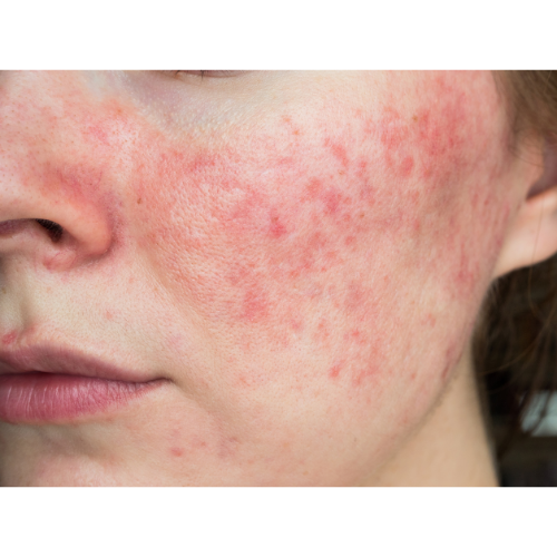 Acn&eacute; rosac&eacute;e ecz&eacute;ma psoariasis boutons foie intestins perturb&eacute;s surcharg&eacute;s lait intol&eacute;rances alimentaires 